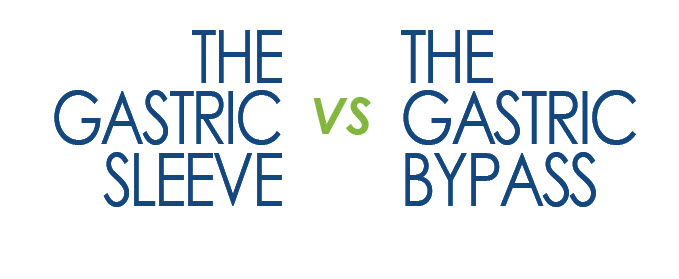 Gastric Sleeve vs Gastric Bypass
