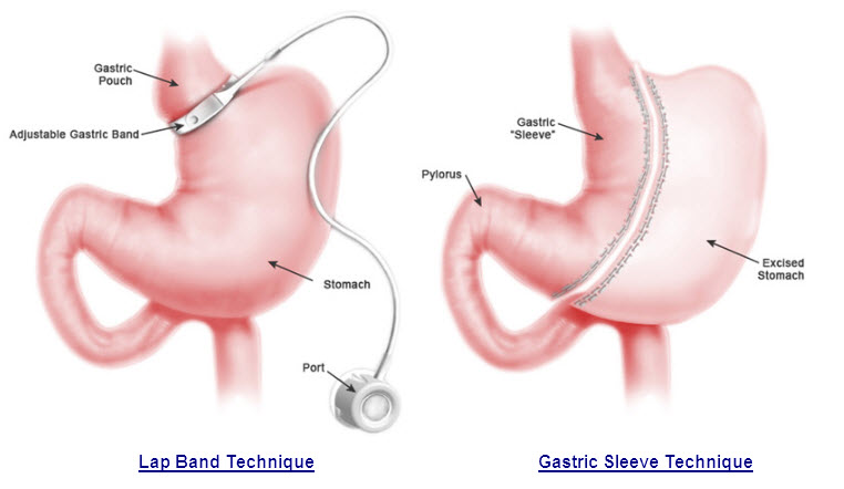 Gastric Sleeve Vs Gastric Band Gastric Sleeve
